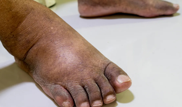 Ozonioterapia ganha respaldo inédito da Anvisa para tratamento de feridas complexas